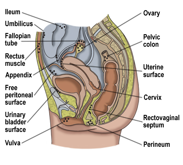 endometriosis.jpg